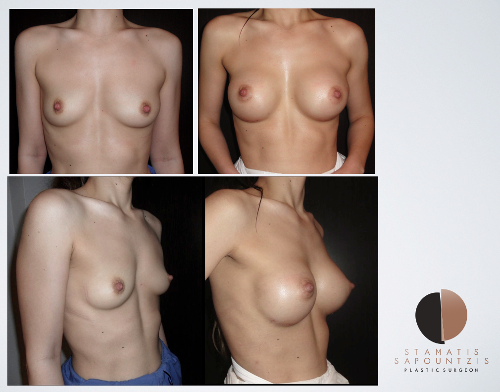 Breast augmentation with anatomical implants – Aυξητική στήθους με ανατομικά ενθέματα