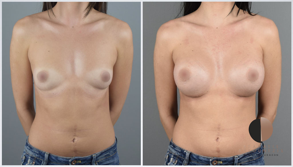 Breast augmentation- Αυξητική στήθους