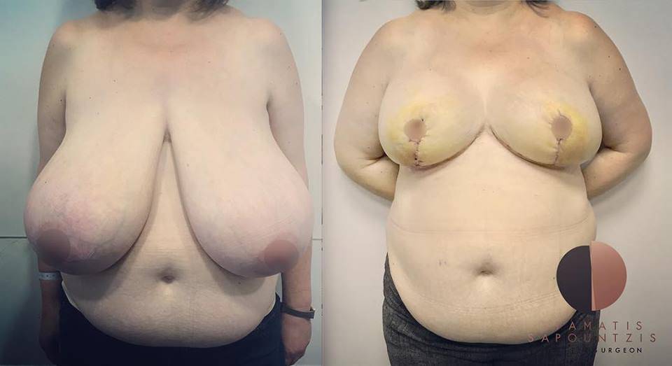 Breast reduction – Μειωτική στήθους