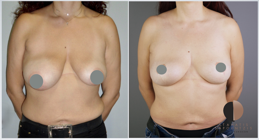 Breast symmetry correction – Διόρθωση ασυμμετρίας μαστών και ανόρθωση