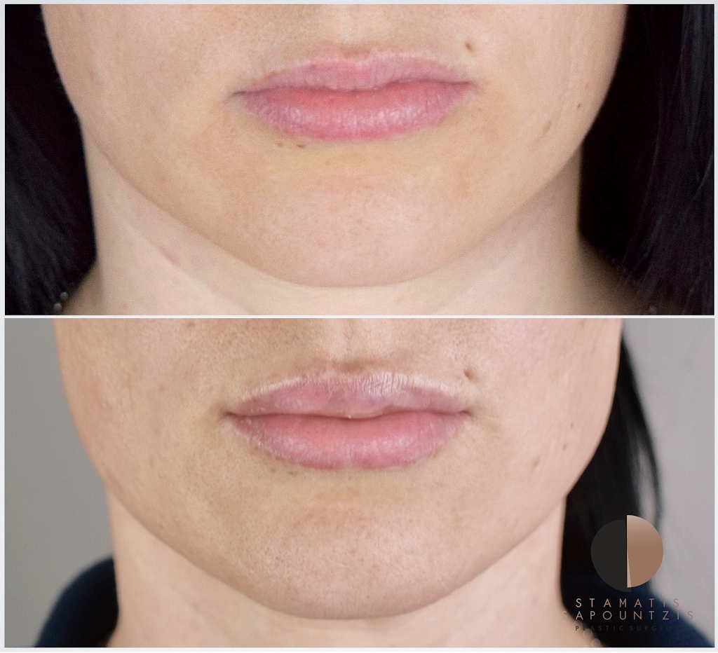 Permalip lip augmentation – Μόνιμη αύξηση χειλιών με ένθεμα σιλικόνης