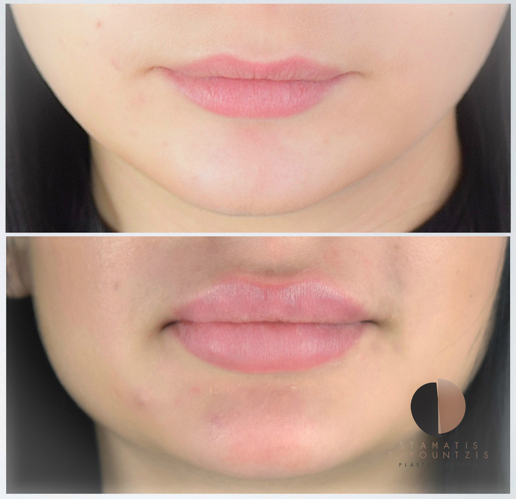 Lip augmentation with filler – Αυξητική χειλέων