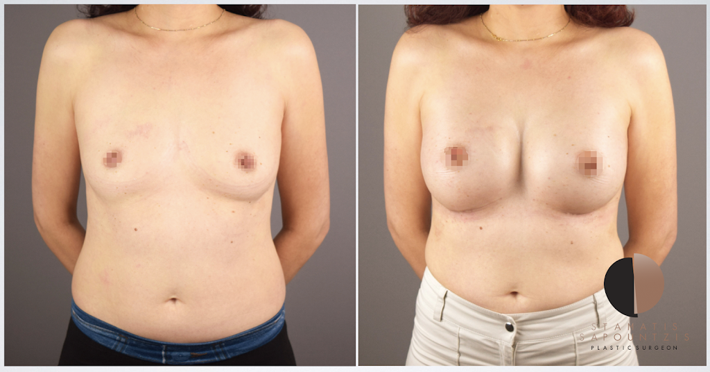 Breast Augmentation – Αυξητική στήθους