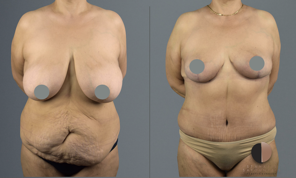 Breast reduction and lipoabdominoplaty – Μειωτική στήθους και λιποκοιλιοπλαστική