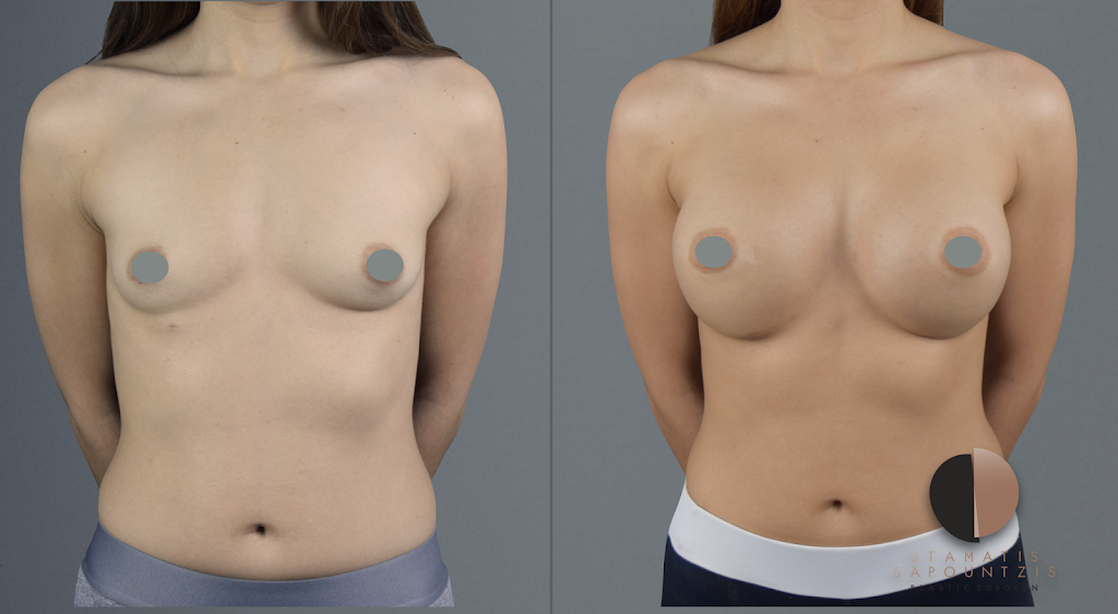 Breast augmentation – αυξητικη στηθους