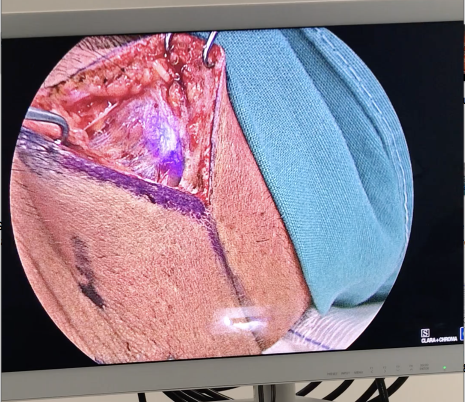 Σύγχρονη τεχνική για την ανίχνευση του φρουρού λεμφαδένα στη χειρουργική αντιμετώπιση του μελανώματος