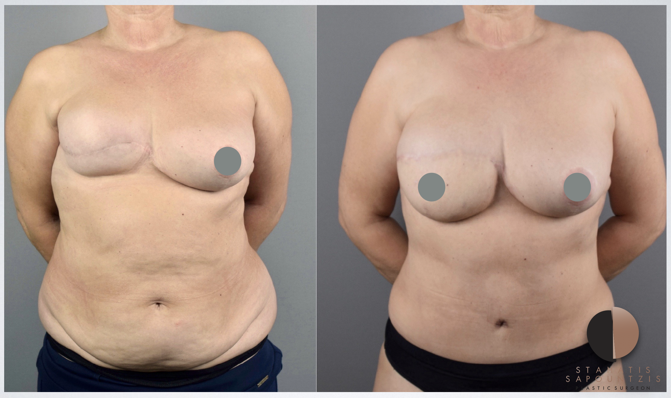Αποκατάσταση μαστού μετά από μαστεκτομή χωρίς ενθέματα σιλικόνης με τη χρήση λίπους και δέρματος από την κοιλιά.